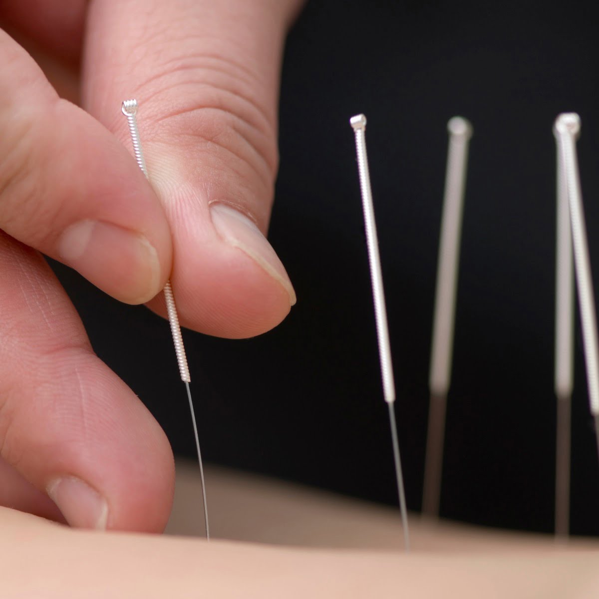 Chinese acupuncture